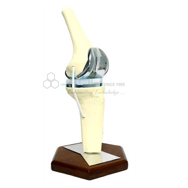 膝盖植入模型