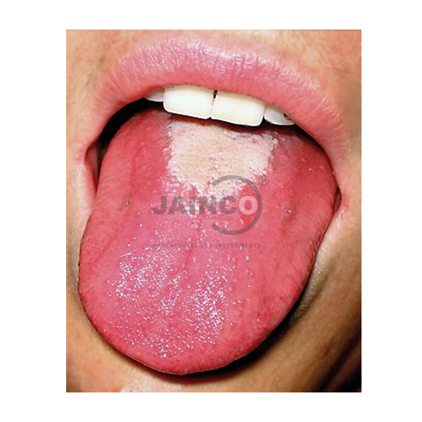 角性口腔炎舌炎模型