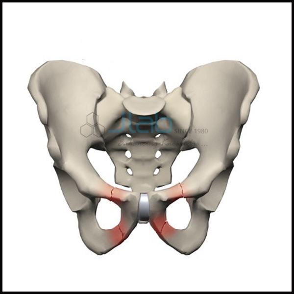 骨盆骨折模型